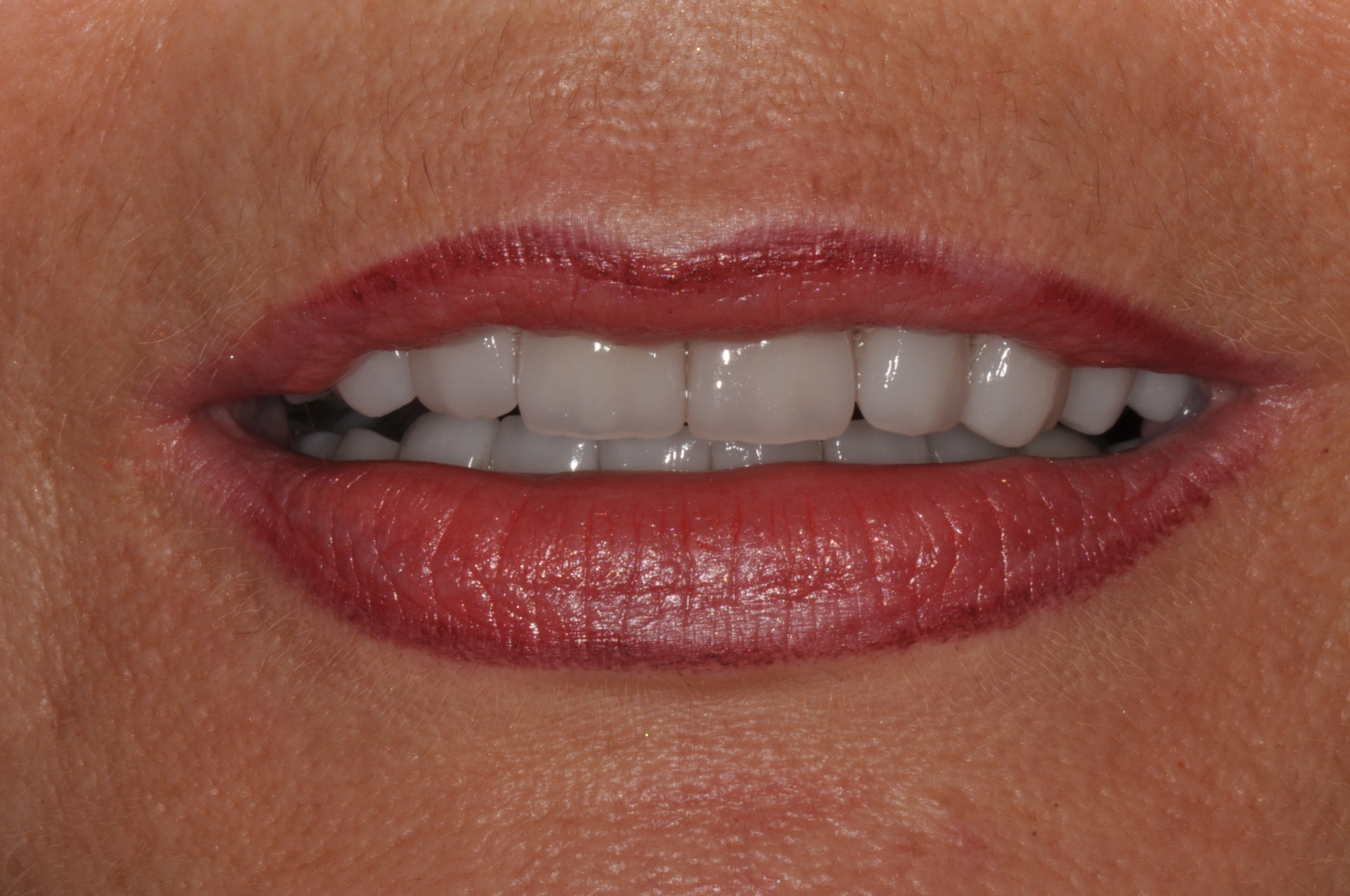 Leuchtende Zähne durch vollkeramische Veneers und Teilkronen in nur 2 Terminen